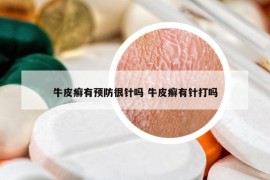 牛皮癬有預(yù)防很針嗎 牛皮癬有針打嗎