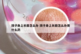孩子身上長蘚怎么辦 孩子身上長蘚怎么辦用什么藥