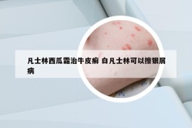 凡士林西瓜霜治牛皮癬 白凡士林可以擦銀屑病