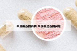 牛皮癬基因藥物 牛皮癬是基因問題