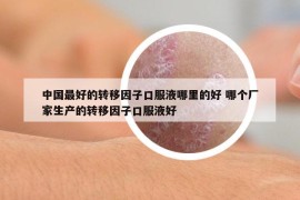 中國最好的轉移因子口服液哪里的好 哪個廠家生產的轉移因子口服液好