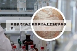 銀屑病只長頭上 銀屑病長頭上怎治療頭發(fā)很長