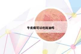 牛皮癬可以吃耗油嗎