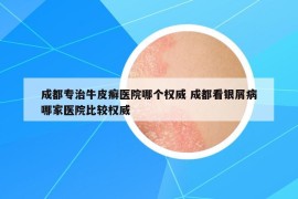 成都專治牛皮癬醫(yī)院哪個權(quán)威 成都看銀屑病哪家醫(yī)院比較權(quán)威
