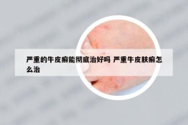 嚴(yán)重的牛皮癬能徹底治好嗎 嚴(yán)重牛皮膚癬怎么治