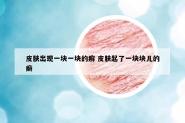 皮膚出現(xiàn)一塊一塊的癬 皮膚起了一塊塊兒的癬