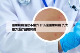 副銀屑病治愈小偏方 什么是副銀屑病 九大偏方治療副銀屑病