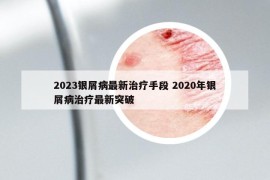 2023銀屑病最新治療手段 2020年銀屑病治療最新突破