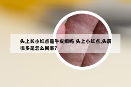 頭上長小紅點(diǎn)是牛皮癬嗎 頭上小紅點(diǎn),頭屑很多是怎么回事?