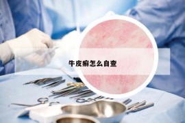 牛皮癬怎么自查