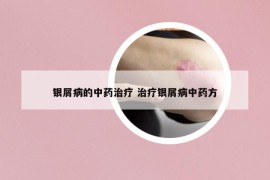 銀屑病的中藥治療 治療銀屑病中藥方