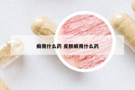 癬用什么藥 皮膚癬用什么藥