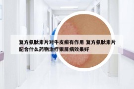 復(fù)方氨肽素片對(duì)牛皮癬有作用 復(fù)方氨肽素片配合什么藥物治療銀屑病效果好
