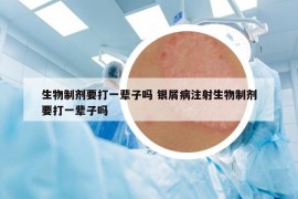 生物制劑要打一輩子嗎 銀屑病注射生物制劑要打一輩子嗎