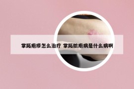掌跖皰疹怎么治療 掌跖膿皰病是什么病啊