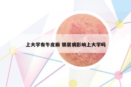 上大學(xué)有牛皮癬 銀屑病影響上大學(xué)嗎
