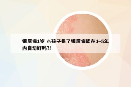 銀屑病1歲 小孩子得了銀屑病能在1~5年內(nèi)自動(dòng)好嗎?!