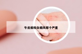 牛皮癬和白癜風(fēng)那個(gè)嚴(yán)重
