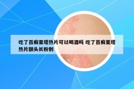 吃了百癬夏塔熱片可以喝酒嗎 吃了百癬夏塔熱片額頭長粉刺