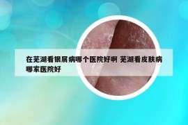 在蕪湖看銀屑病哪個醫(yī)院好啊 蕪湖看皮膚病哪家醫(yī)院好