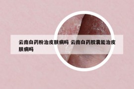 云南白藥粉治皮膚病嗎 云南白藥膠囊能治皮膚病嗎