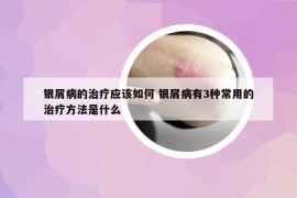 銀屑病的治療應該如何 銀屑病有3種常用的治療方法是什么