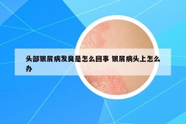 頭部銀屑病發(fā)臭是怎么回事 銀屑病頭上怎么辦
