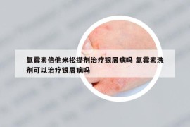 氯霉素倍他米松搽劑治療銀屑病嗎 氯霉素洗劑可以治療銀屑病嗎