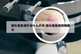 額頭銀屑病外涂什么藥膏 額頭銀屑病初期圖片