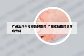 廣州治療牛皮癬最好醫(yī)院 廣州皮膚醫(yī)院銀屑病?？? /></a>		
		</figure>

		<header class=