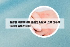 丘疹性尋麻疹和銀屑病怎么區(qū)別 丘疹性尋麻疹和尋麻疹的區(qū)別