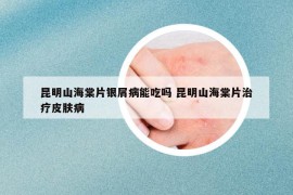 昆明山海棠片銀屑病能吃嗎 昆明山海棠片治療皮膚病
