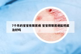 7個月的寶寶有銀屑病 寶寶得銀屑病能徹底治好嗎