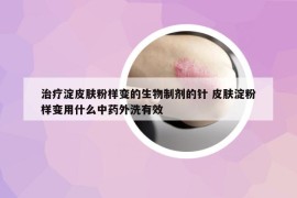 治療淀皮膚粉樣變的生物制劑的針 皮膚淀粉樣變用什么中藥外洗有效