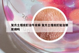 復(fù)方土槿皮酊治牛皮癬 復(fù)方土槿皮酊能治銀屑病嗎