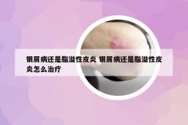 銀屑病還是脂溢性皮炎 銀屑病還是脂溢性皮炎怎么治療