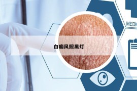 白癜風(fēng)照黑燈