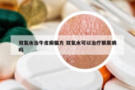 雙氧水治牛皮癬偏方 雙氧水可以治療銀屑病嗎