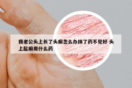 我老公頭上長了頭癬怎么辦抹了藥不見好 頭上起癬用什么藥