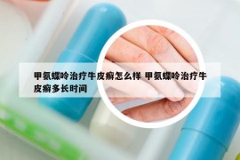 甲氨蝶呤治療牛皮癬怎么樣 甲氨蝶呤治療牛皮癬多長(zhǎng)時(shí)間