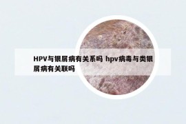 HPV與銀屑病有關系嗎 hpv病毒與類銀屑病有關聯(lián)嗎