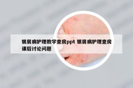 銀屑病護理教學(xué)查房ppt 銀屑病護理查房課后討論問題