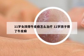 11歲女孩得牛皮癬怎么治療 12歲孩子得了牛皮癬