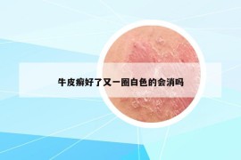 牛皮癬好了又一圈白色的會(huì)消嗎