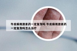 牛皮癬用激素藥一定復(fù)發(fā)嗎 牛皮癬用激素藥一定復(fù)發(fā)嗎怎么治療