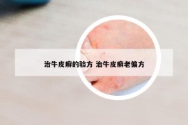 治牛皮癬的驗方 治牛皮癬老偏方