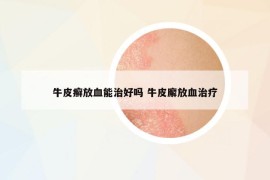 牛皮癬放血能治好嗎 牛皮廨放血治療