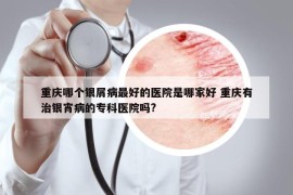 重慶哪個(gè)銀屑病最好的醫(yī)院是哪家好 重慶有治銀宵病的專科醫(yī)院嗎?