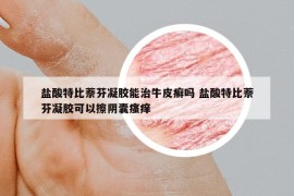鹽酸特比萘芬凝膠能治牛皮癬嗎 鹽酸特比萘芬凝膠可以擦陰囊瘙癢