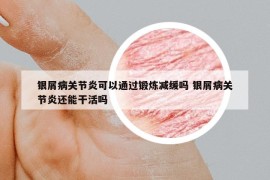 銀屑病關(guān)節(jié)炎可以通過(guò)鍛煉減緩嗎 銀屑病關(guān)節(jié)炎還能干活嗎